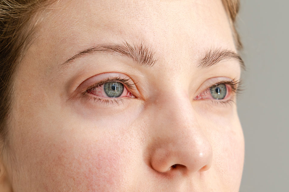 Dry Eyes Aren’t Just Annoying: When Dry Eye Needs Medical Treatment